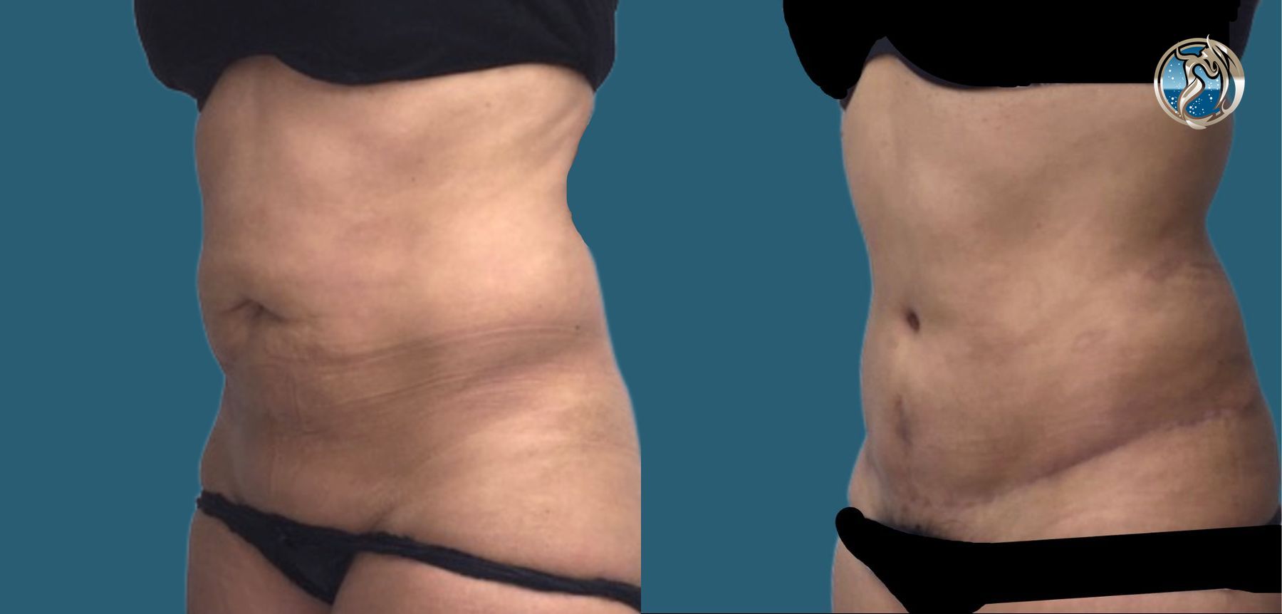 Before and after Tummy Tuck case 46061 - Angle 3