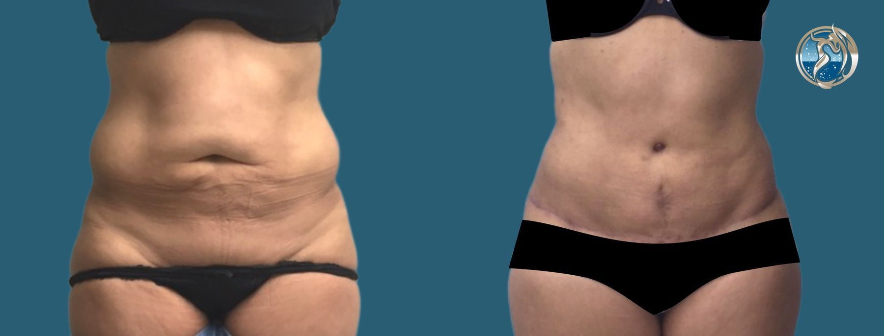 Before and after Tummy Tuck case 46061