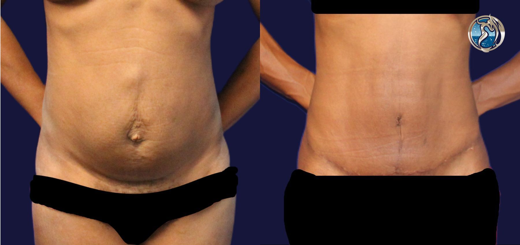 Before and after Tummy Tuck case 43791
