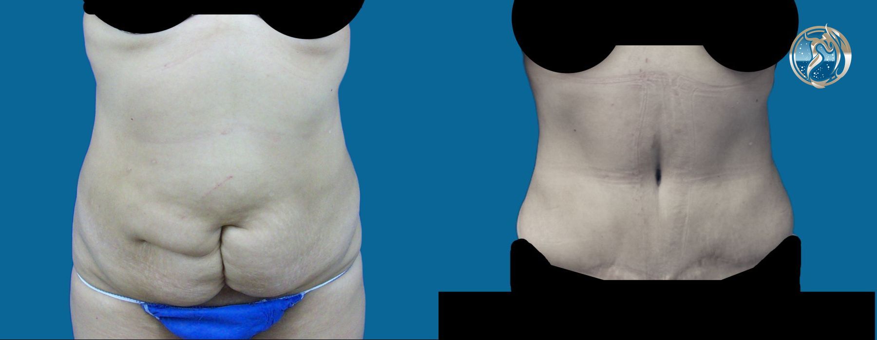 Before and after photo set of body contouring tummy tuck by Dr. Orna Fisher in San Mateo, CA