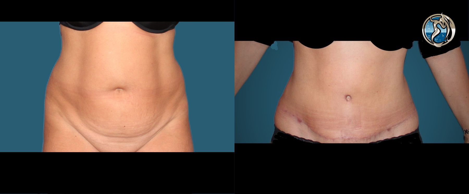 Before and after photo set of tummy tuck with lipo by Dr. Orna Fisher in San Mateo, CA