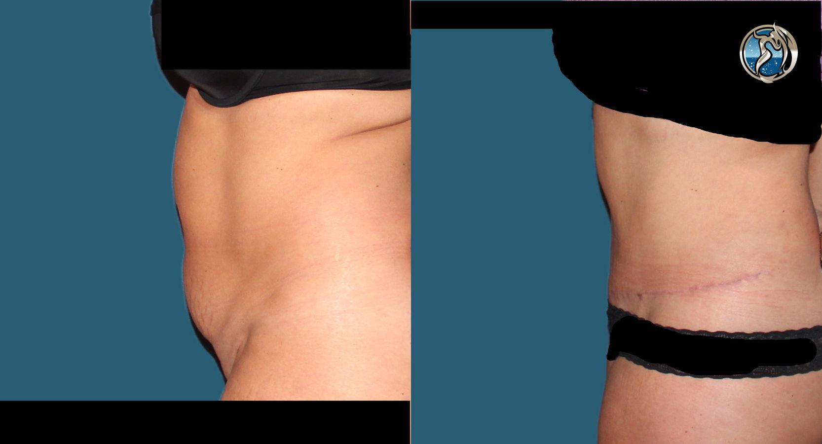 Before and after photo set of tummy tuck with lipo by Dr. Orna Fisher in San Mateo, CA - Angle 4