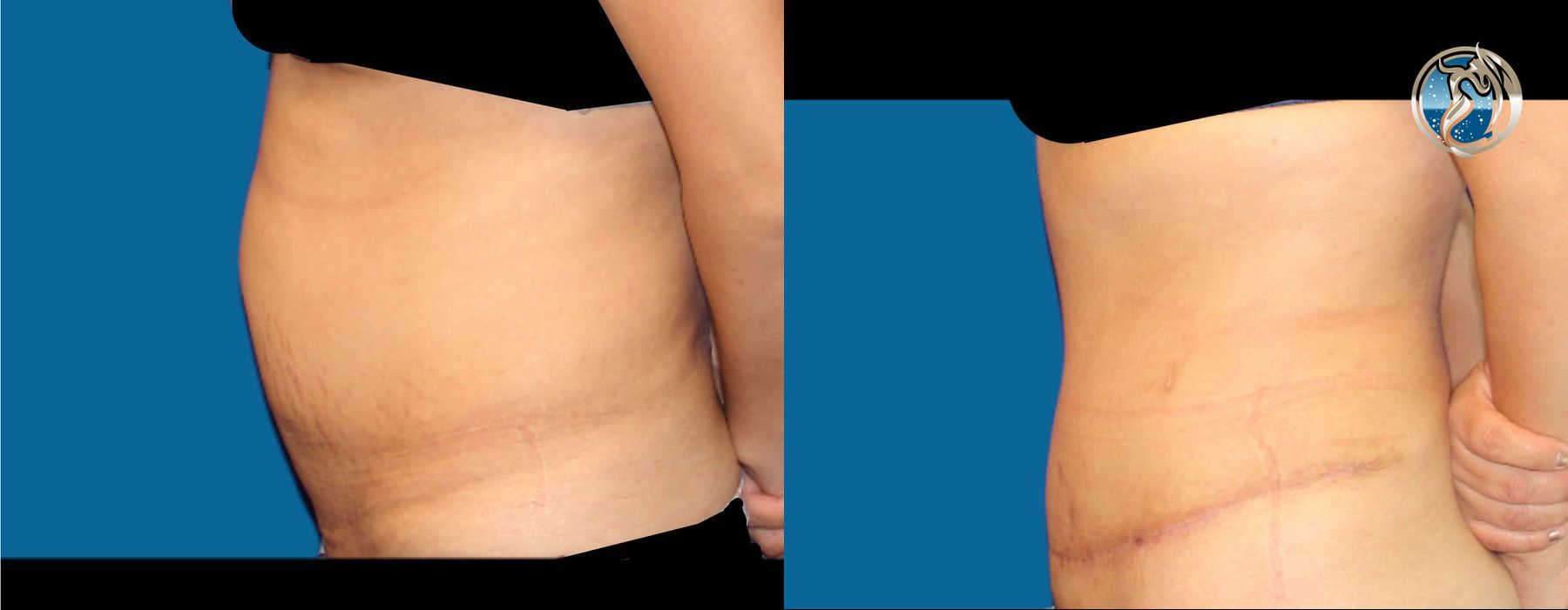 photos of tummy tuck and waist liposuction by Dr. Orna Fisher in San Mateo, CA - Angle 3