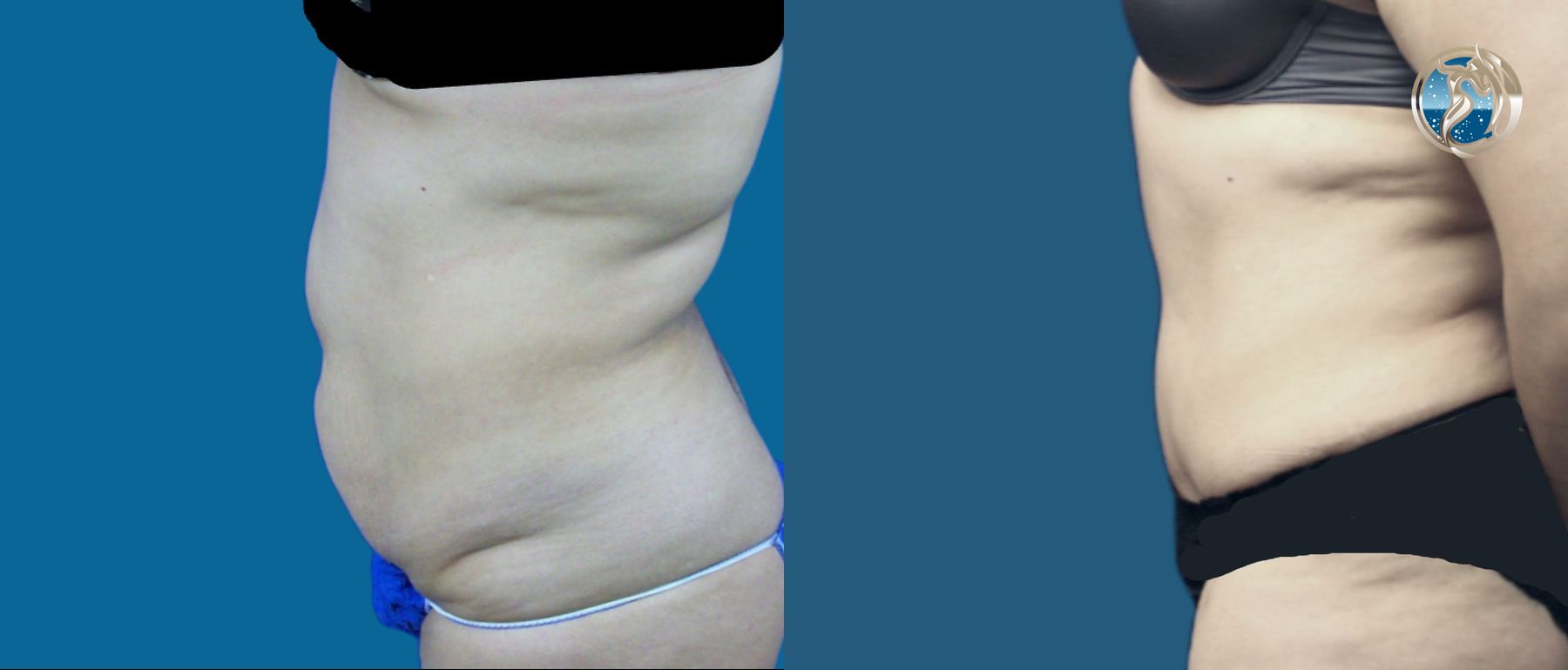 Before and after photo set of body contouring tummy tuck by Dr. Orna Fisher in San Mateo, CA - Angle 3