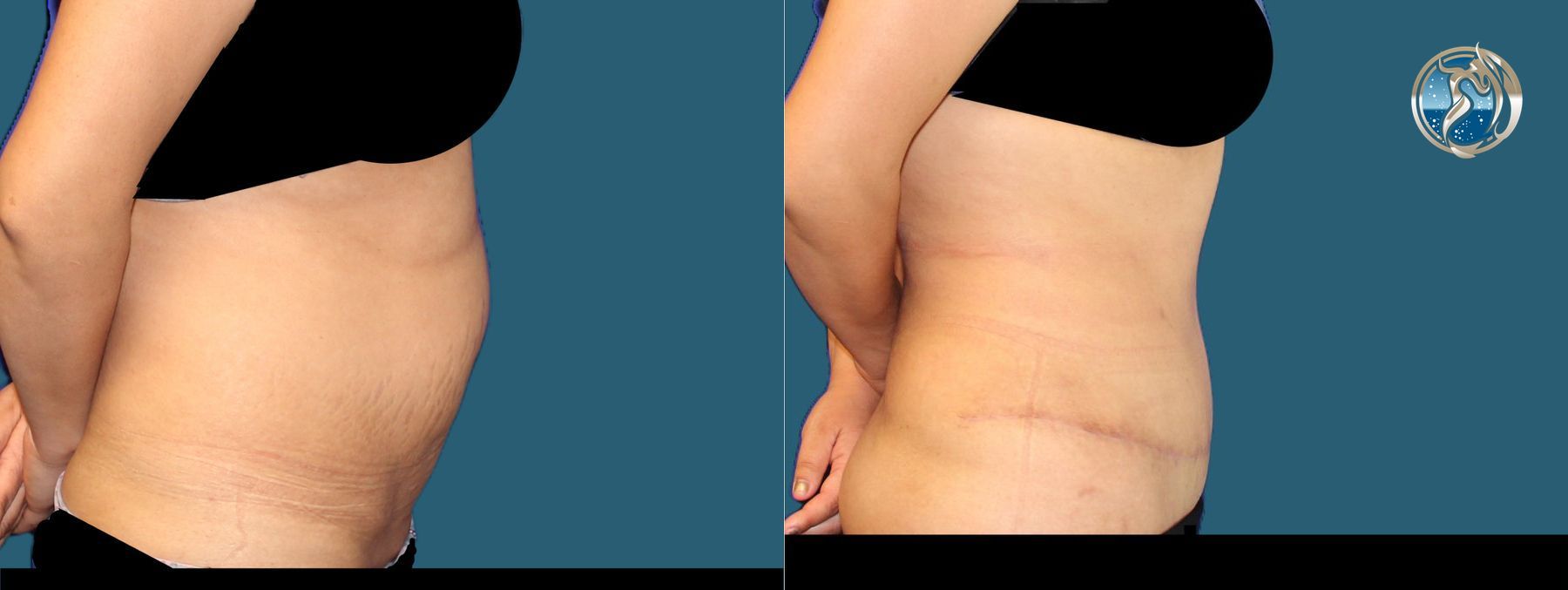 photos of tummy tuck and waist liposuction by Dr. Orna Fisher in San Mateo, CA - Angle 2