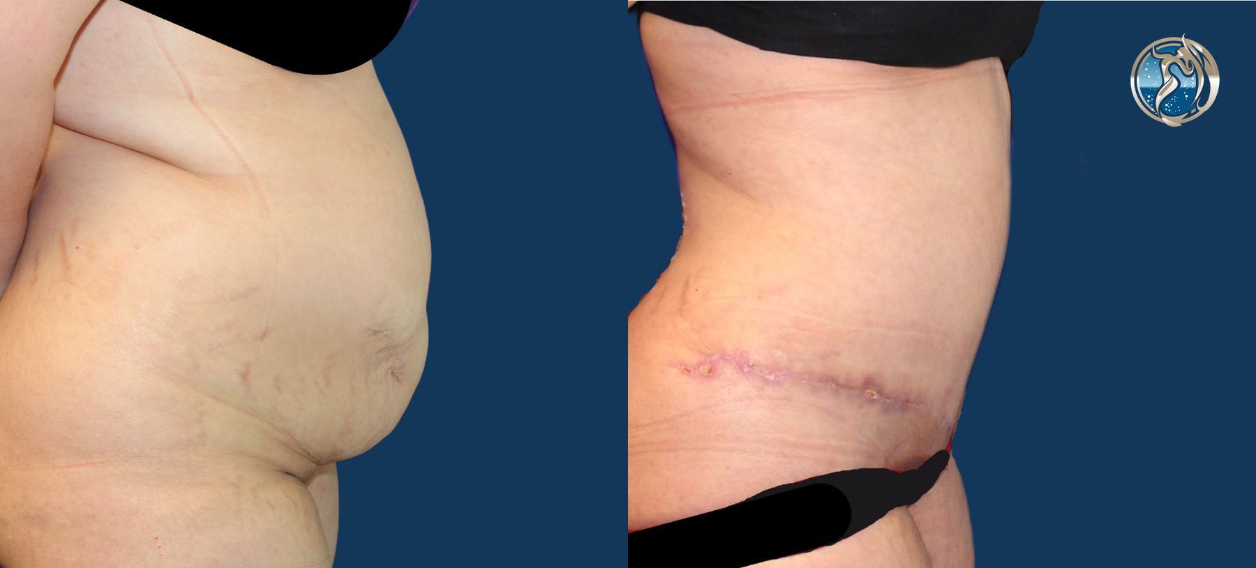 Before and after photo set of Abdominoplasty with lipo by Dr. Orna Fisher in San Mateo, CA - Angle 3