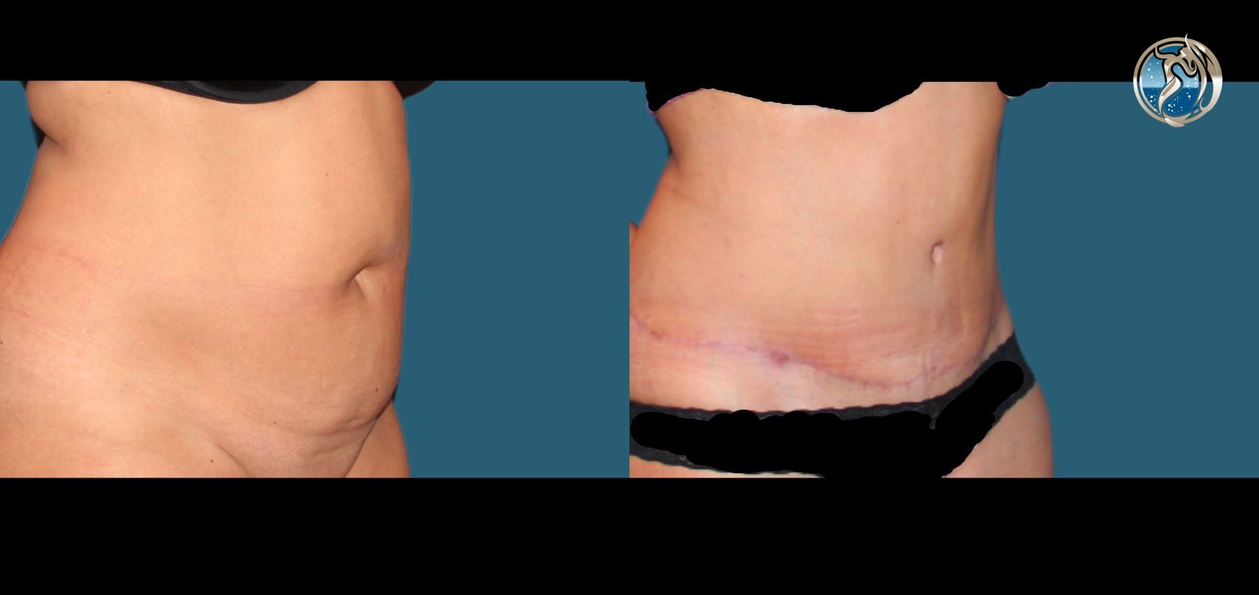 Before and after photo set of tummy tuck with lipo by Dr. Orna Fisher in San Mateo, CA - Angle 3