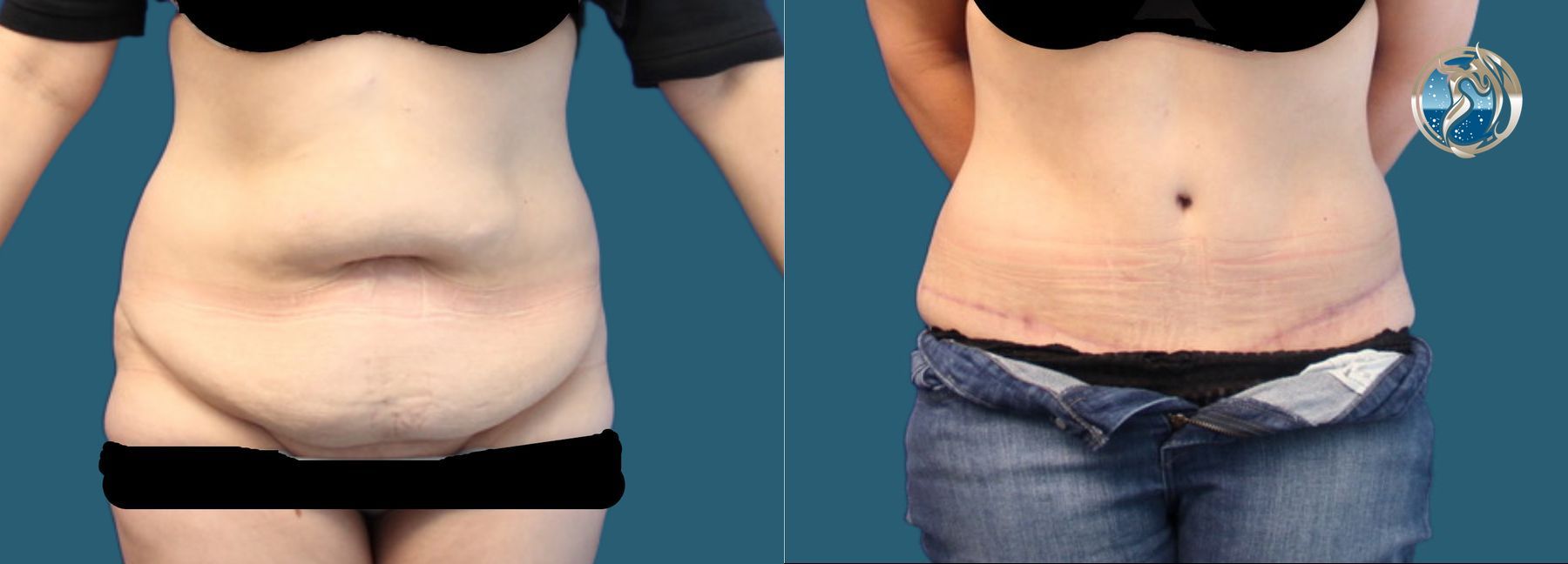 Before and after photo set of tummy tuck with lipo by Dr. Orna Fisher in San Mateo, CA