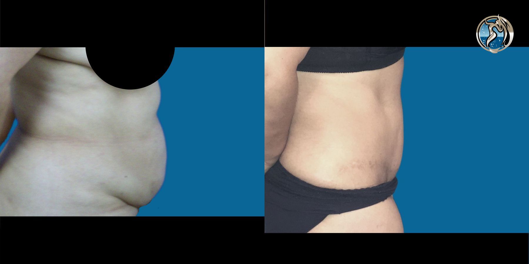 Before and after photo set of tummy tuck by Dr. Orna Fisher in San Mateo, CA - Angle 3
