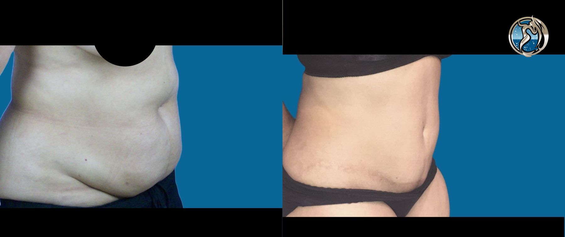 Before and after photo set of tummy tuck by Dr. Orna Fisher in San Mateo, CA - Angle 2