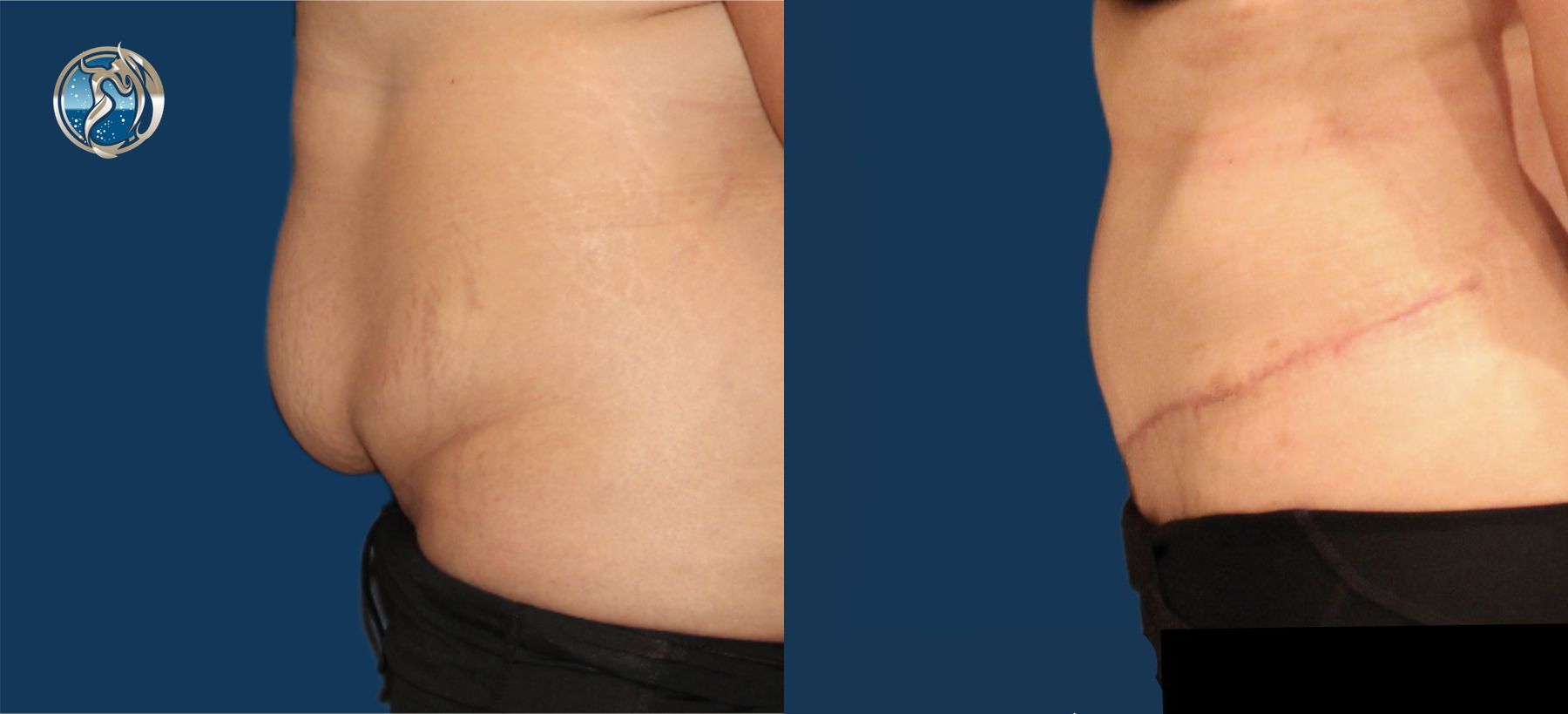 Before and after Tummy Tuck case 43754 - Angle 3