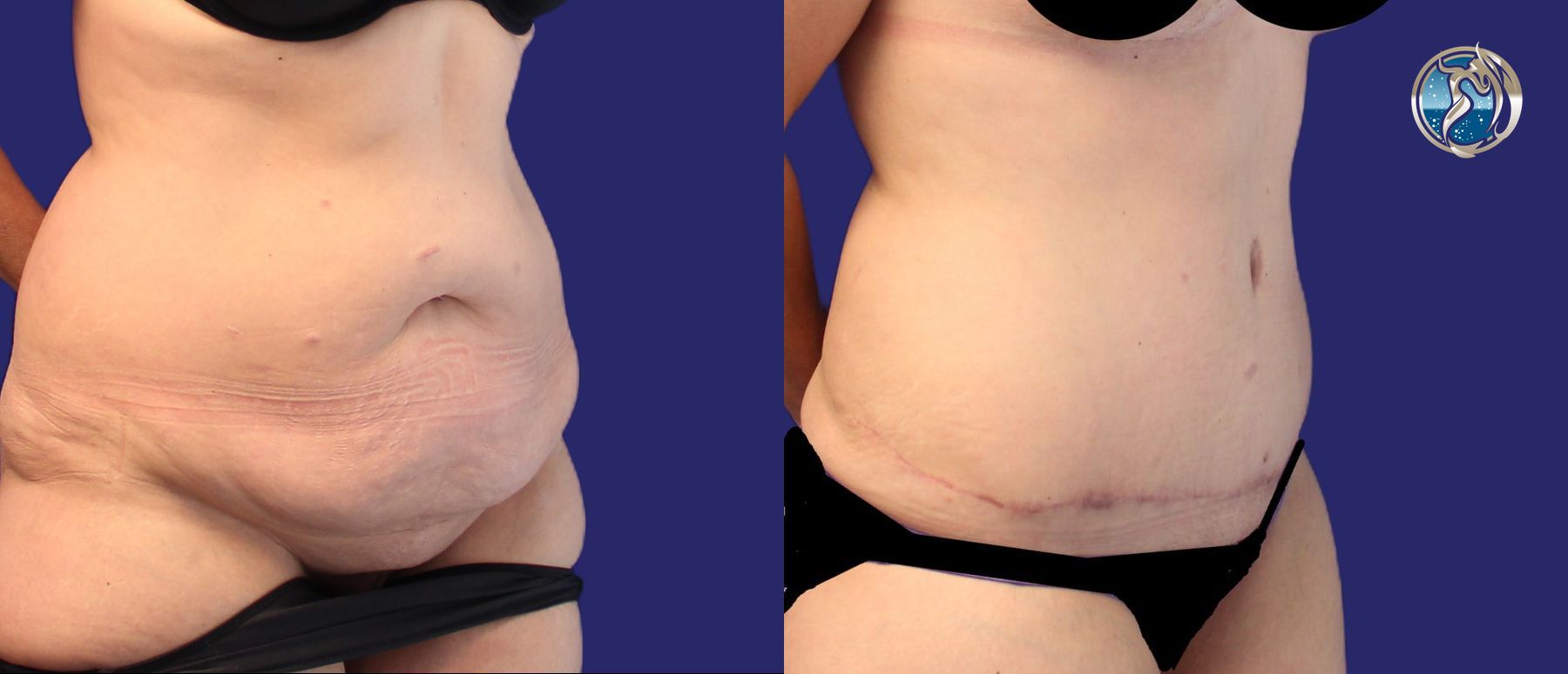 Before and after photo set of tummy tuck after weight loss by Dr. Orna Fisher in San Mateo, CA - Angle 4
