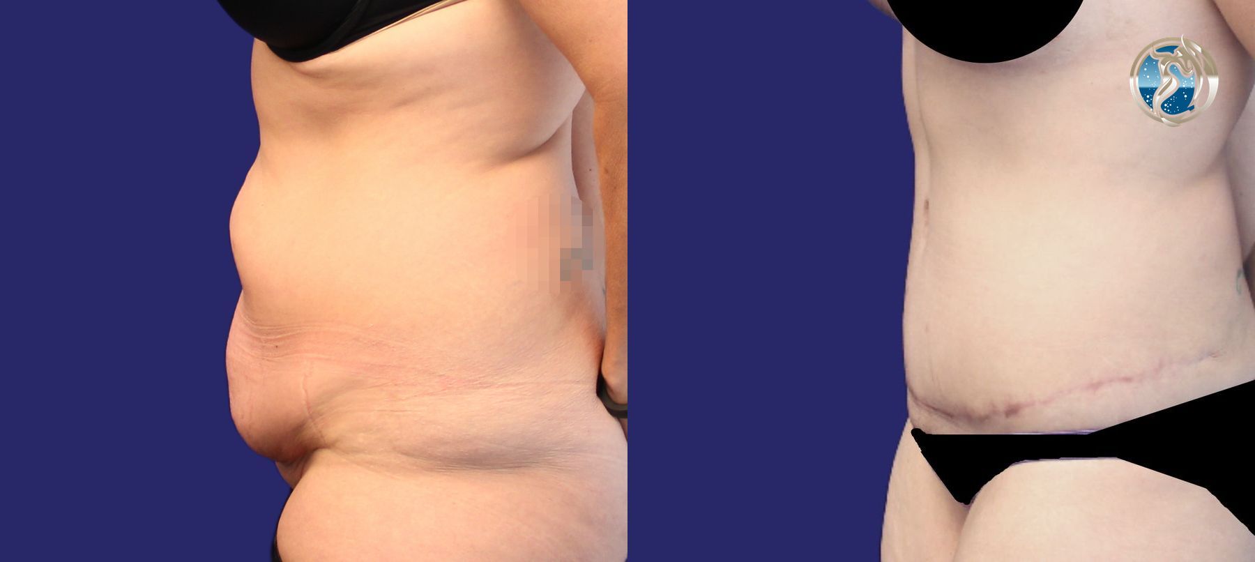 Before and after photo set of tummy tuck after weight loss by Dr. Orna Fisher in San Mateo, CA - Angle 3