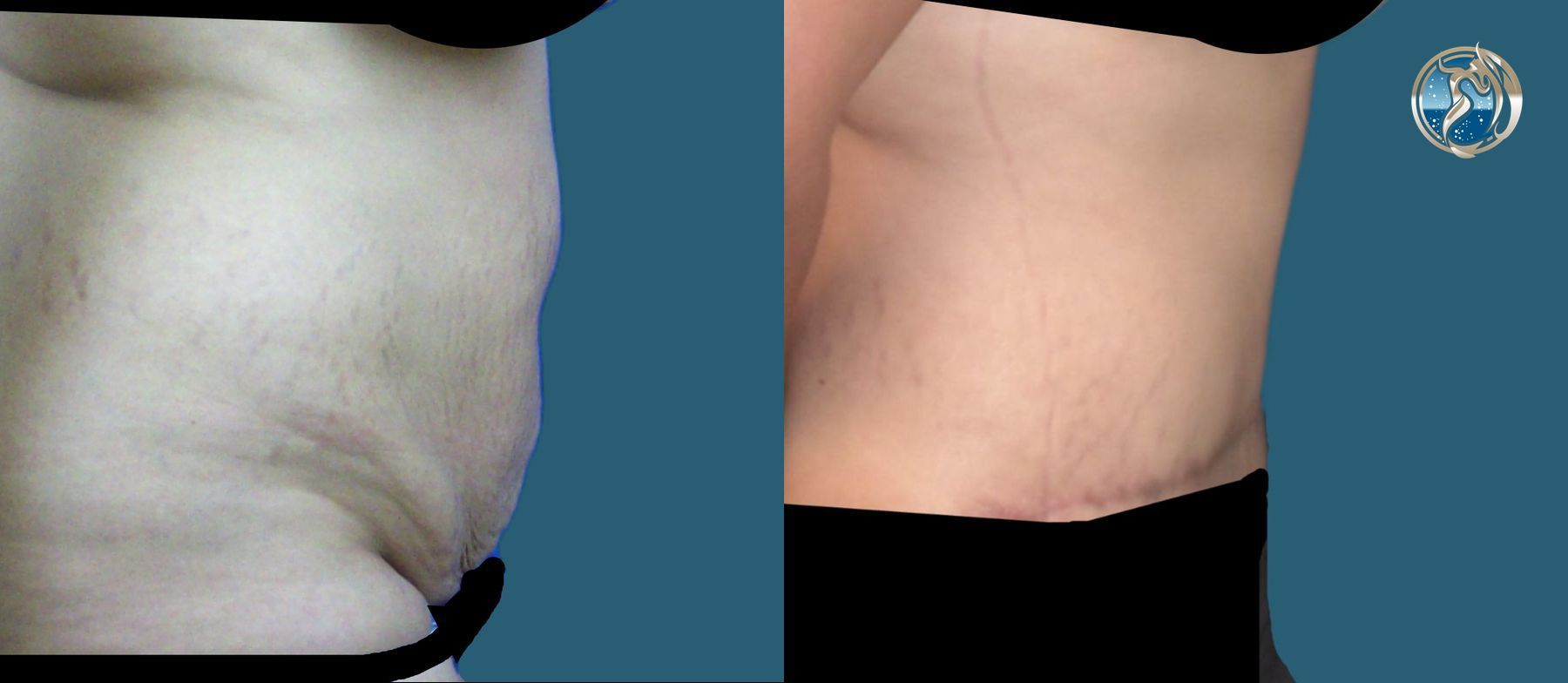 Before and after photo set of tummy tuck with lipo by Dr. Orna Fisher in San Mateo, CA - Angle 2