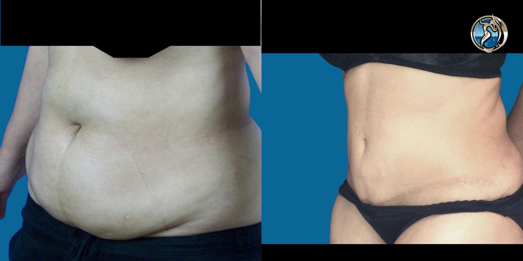 Before and after photo set of tummy tuck by Dr. Orna Fisher in San Mateo, CA - Angle 4