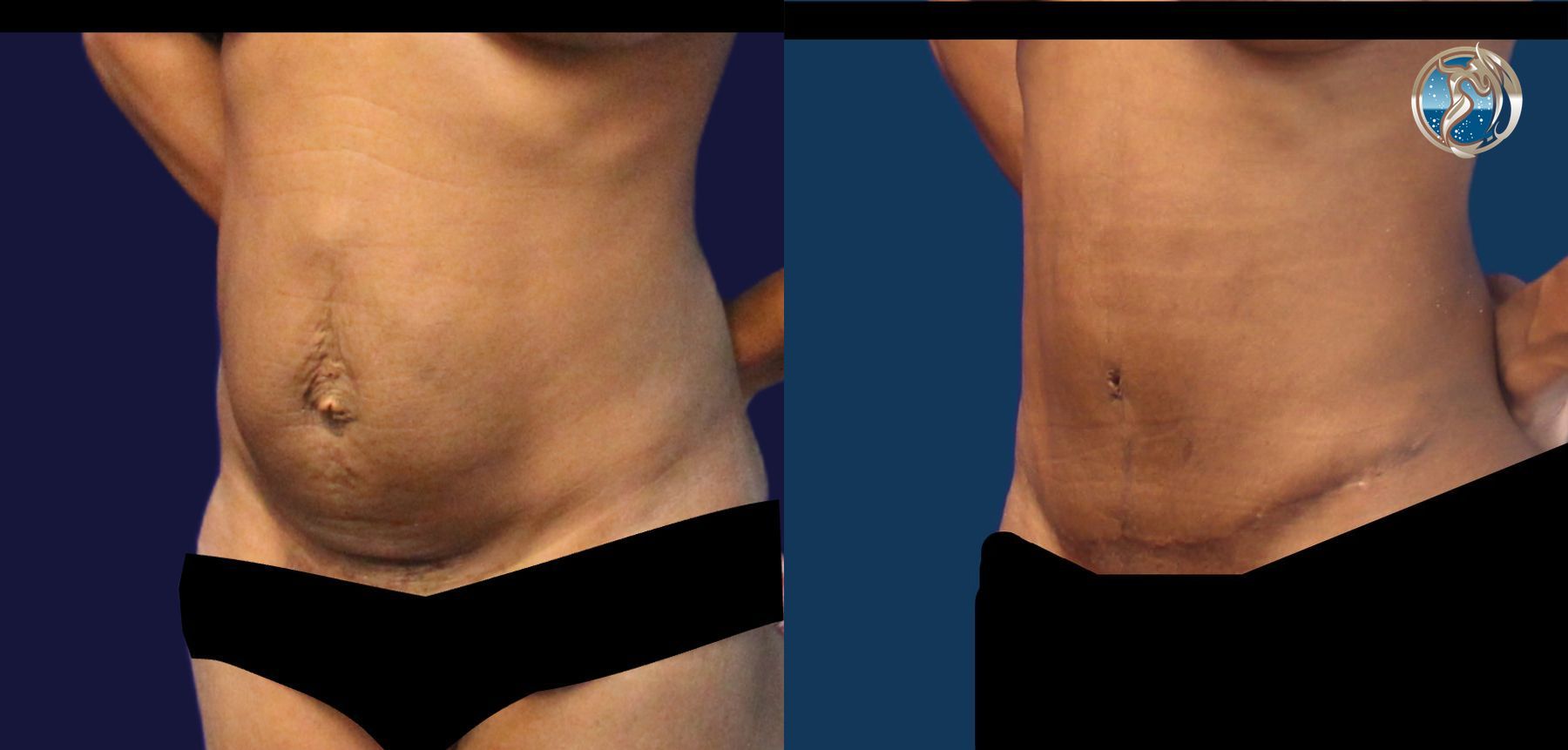 Before and after Tummy Tuck case 43791 - Angle 2