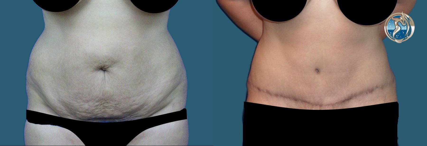 Before and after photo set of tummy tuck with lipo by Dr. Orna Fisher in San Mateo, CA
