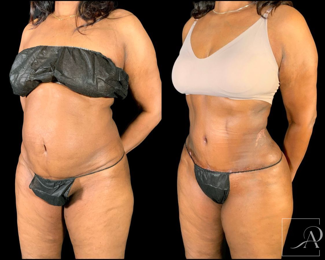 Before and after Brazilian Butt Lift case 49553 - Angle 2