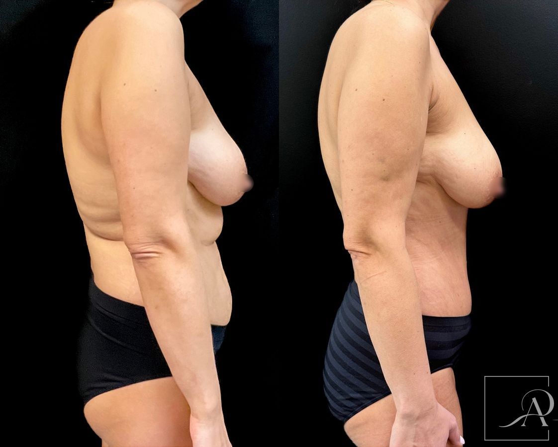 Before and after Tummy Tuck case 43665 - Angle 4