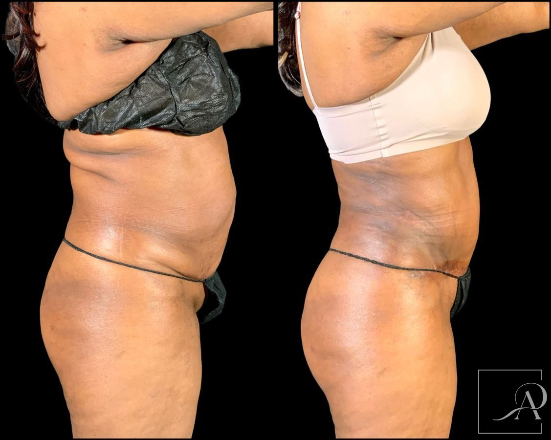 Before and after Brazilian Butt Lift case 49553 - Angle 6