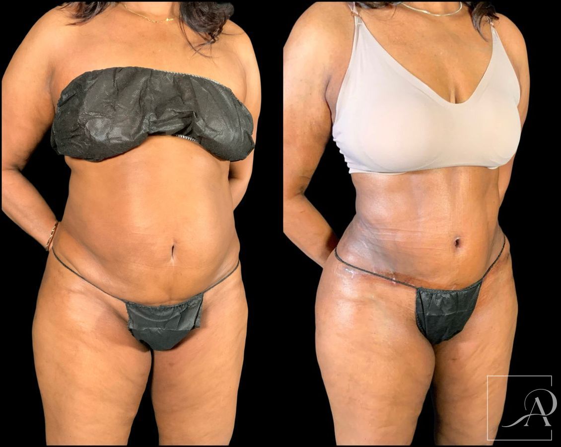 Before and after Brazilian Butt Lift case 49553 - Angle 5