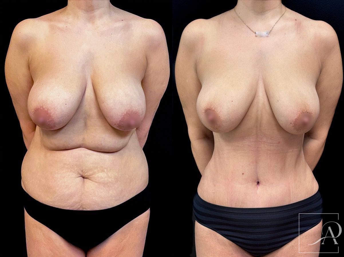 Before and after Tummy Tuck case 43665 - Angle 3