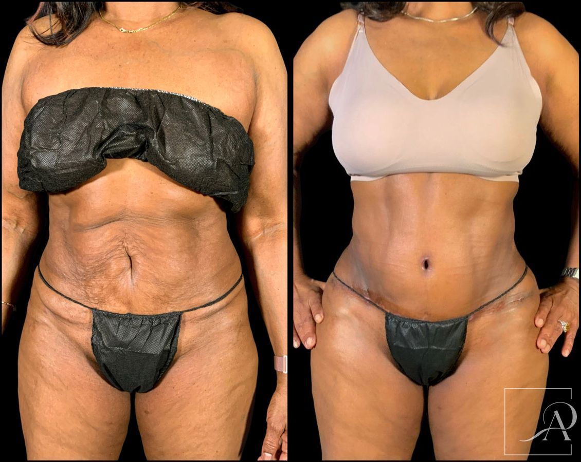 Before and after Brazilian Butt Lift case 49553 - Angle 3