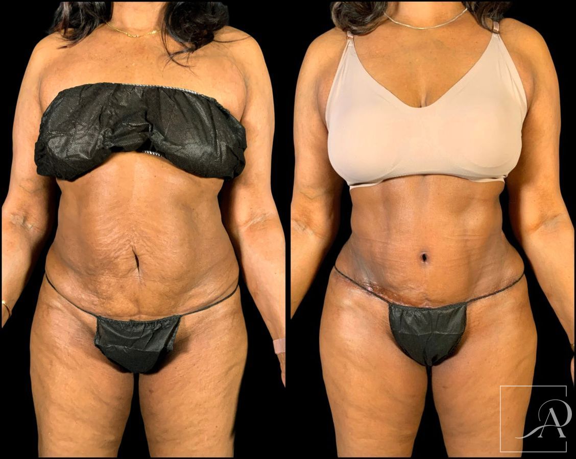 Before and after Brazilian Butt Lift case 49553 - Angle 4