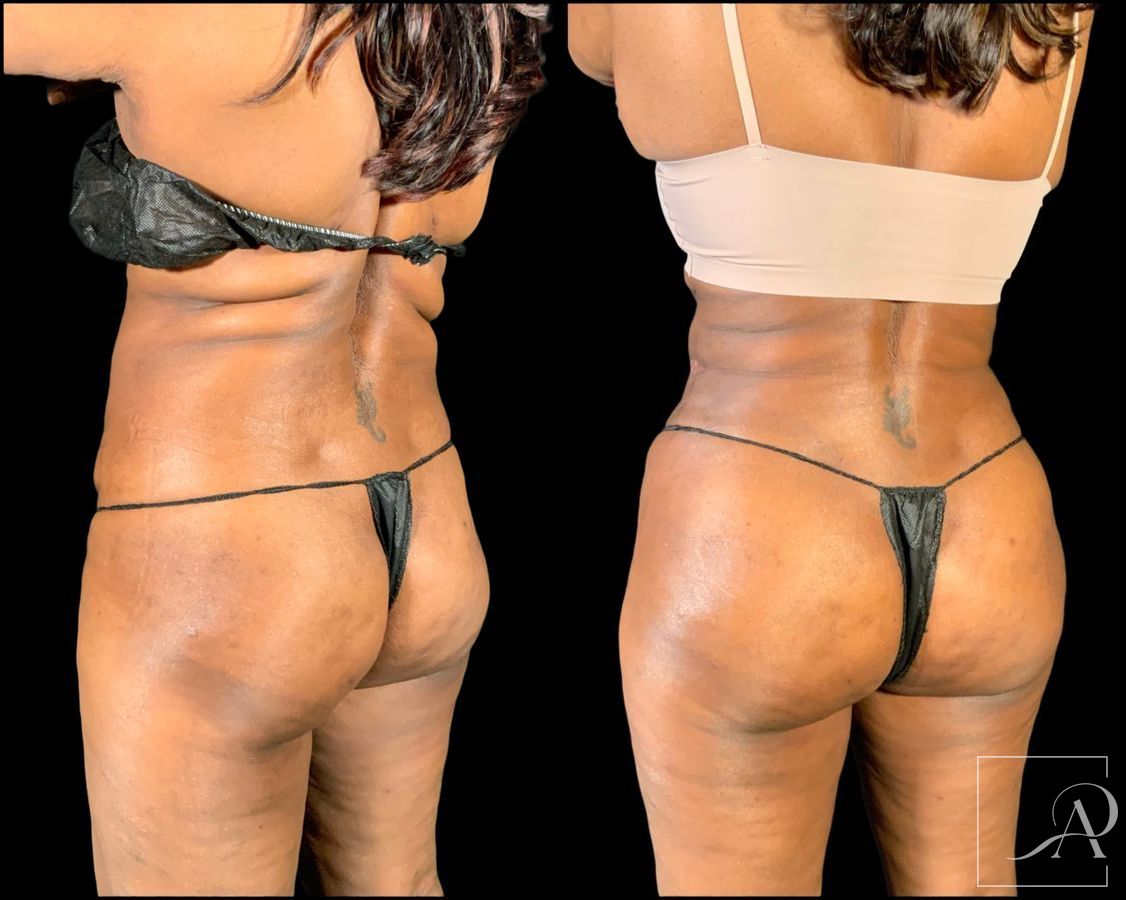Before and after Brazilian Butt Lift case 49553 - Angle 9