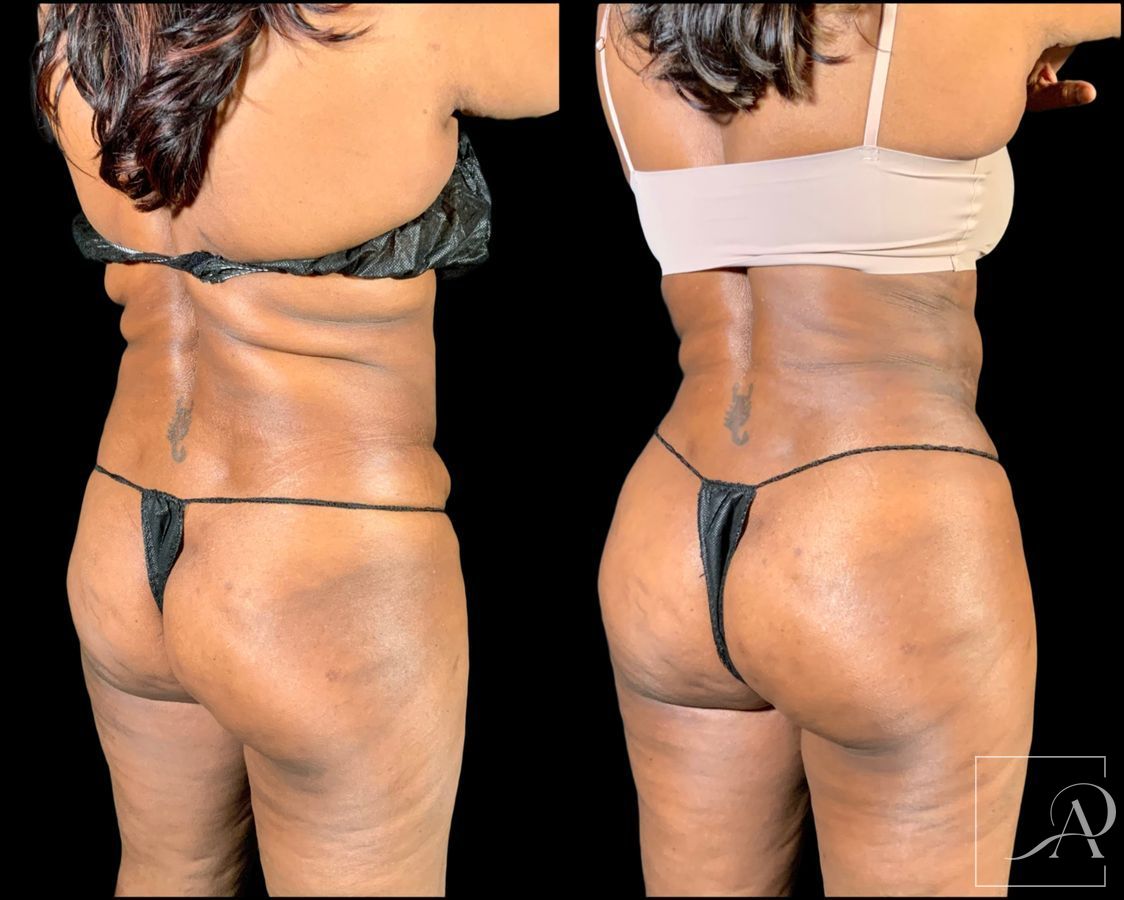 Before and after Brazilian Butt Lift case 49553 - Angle 7