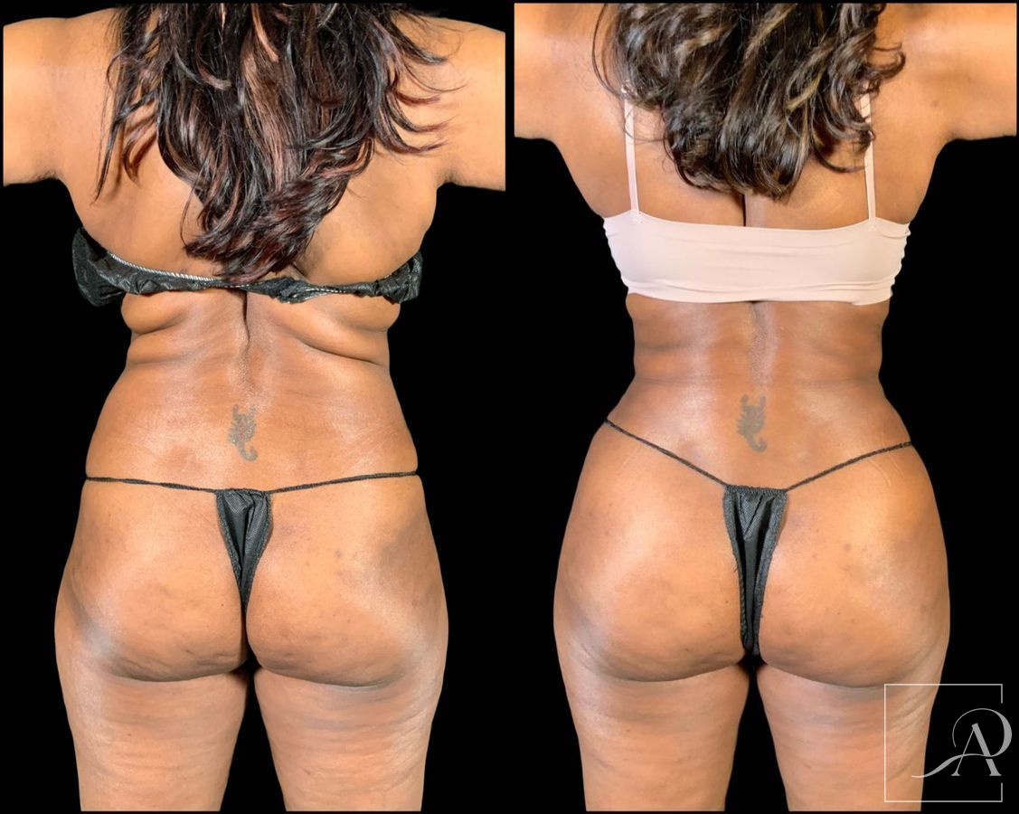 Before and after Brazilian Butt Lift case 49553 - Angle 8