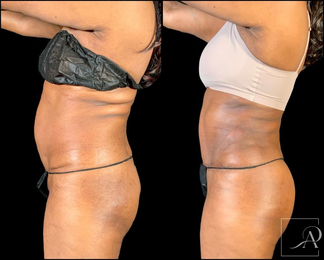 Before and after Brazilian Butt Lift case 49553