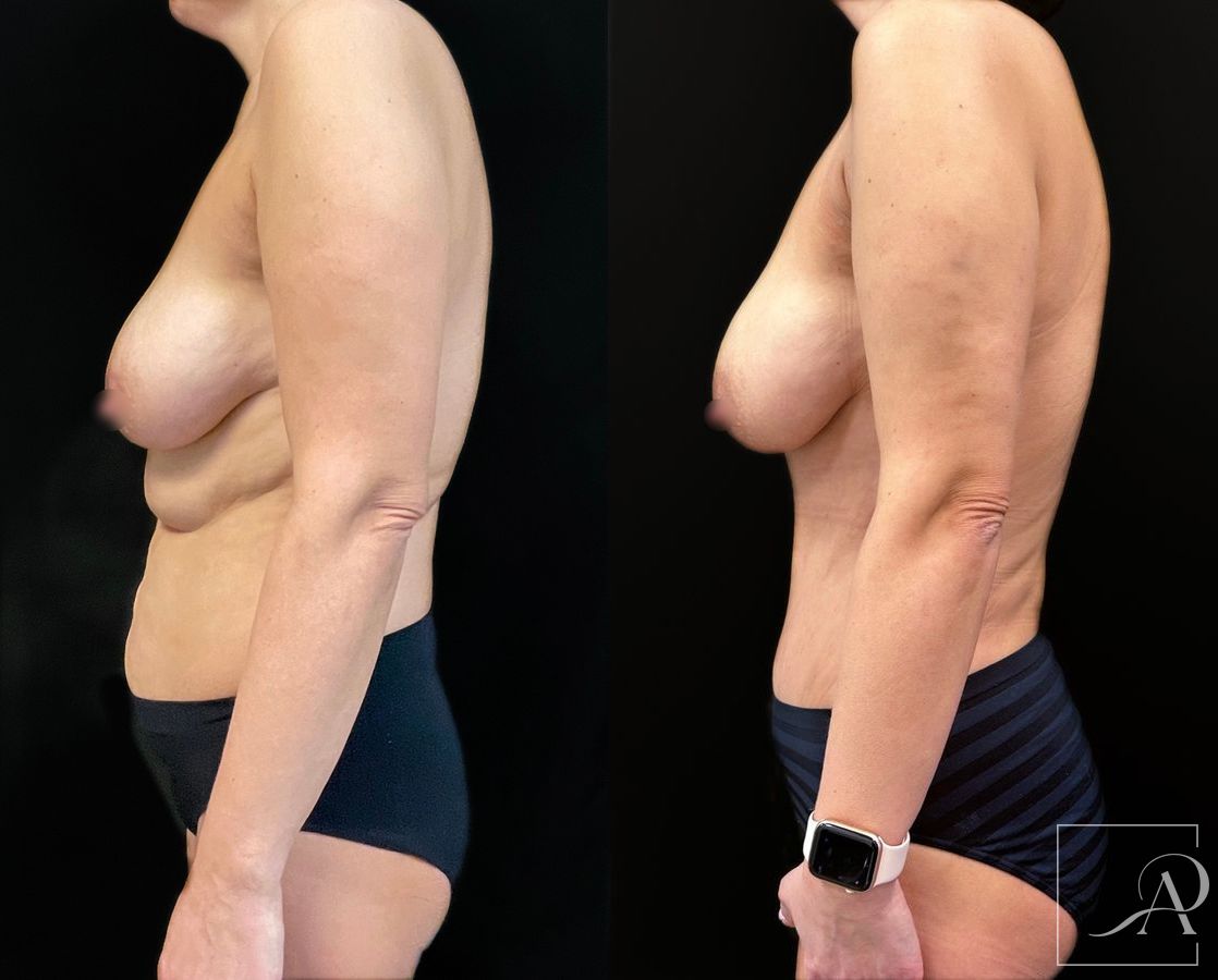 Before and after Tummy Tuck case 43665
