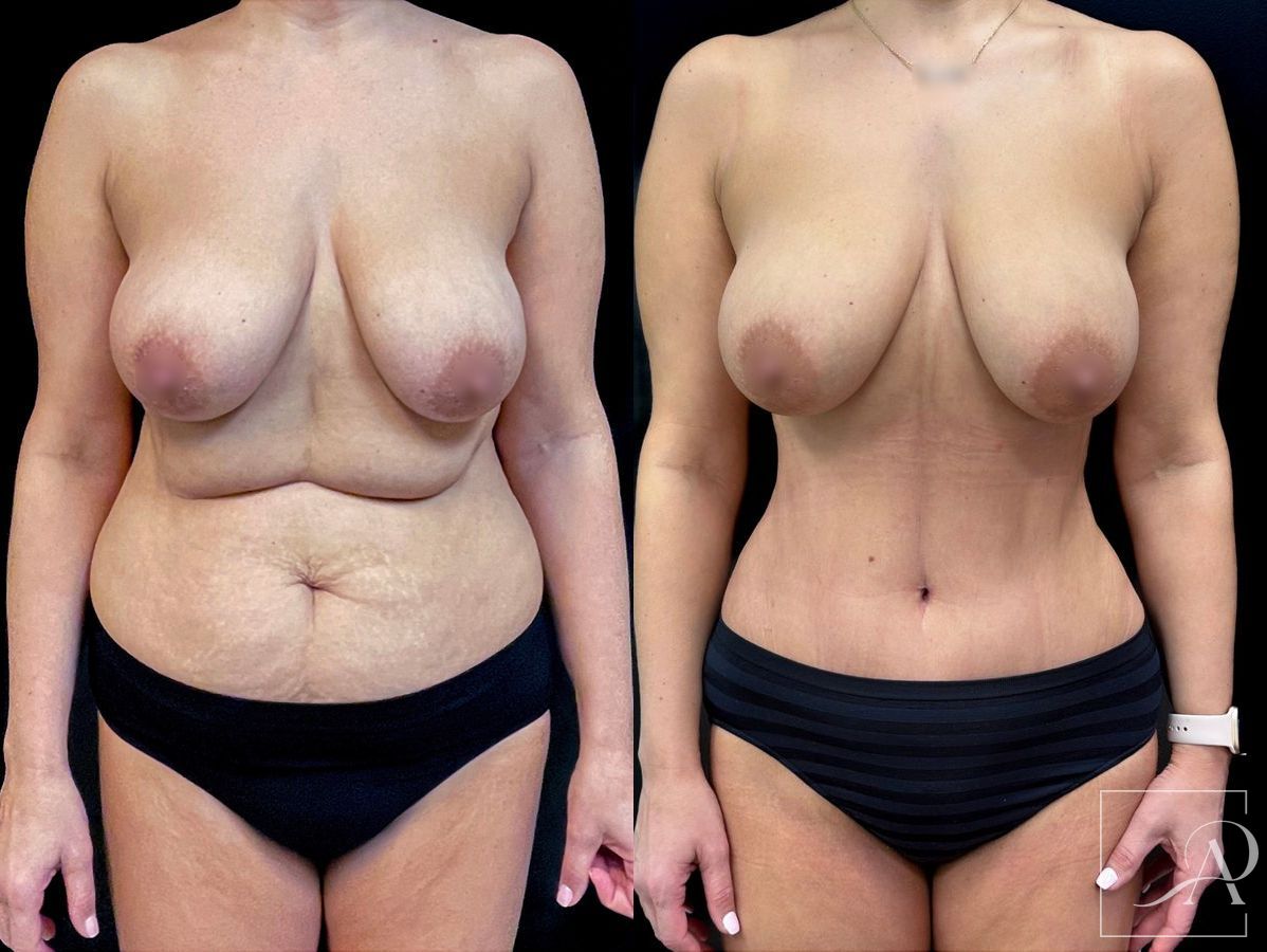 Before and after Tummy Tuck case 43665 - Angle 2
