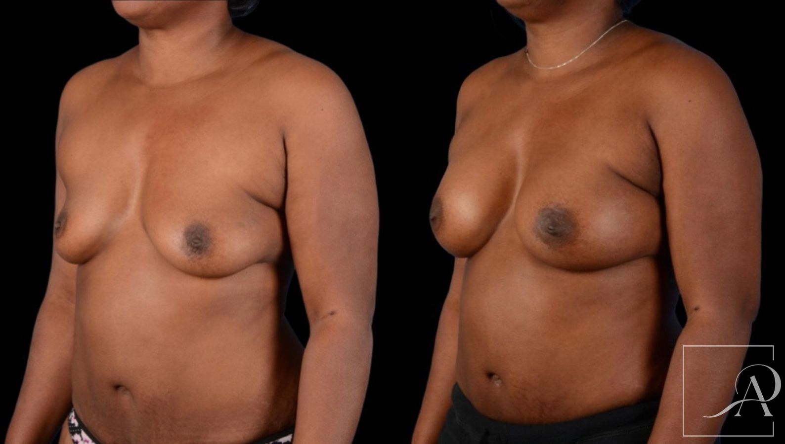 Before and after Breast Augmentation case 43366 - Angle 2