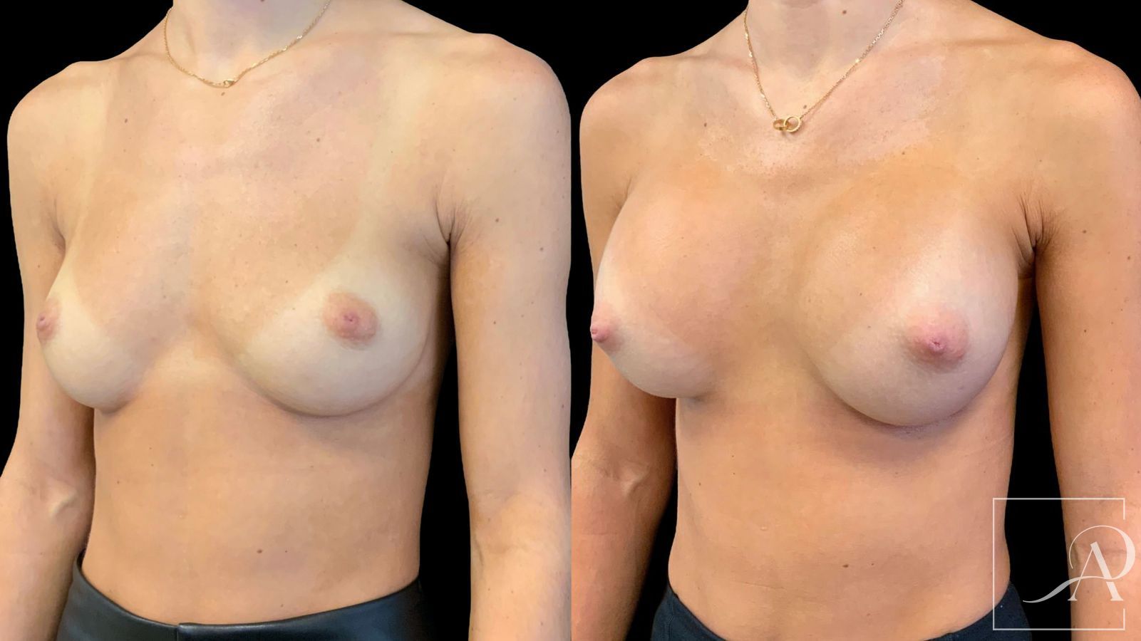 Before and after Breast Augmentation case 43365 - Angle 2