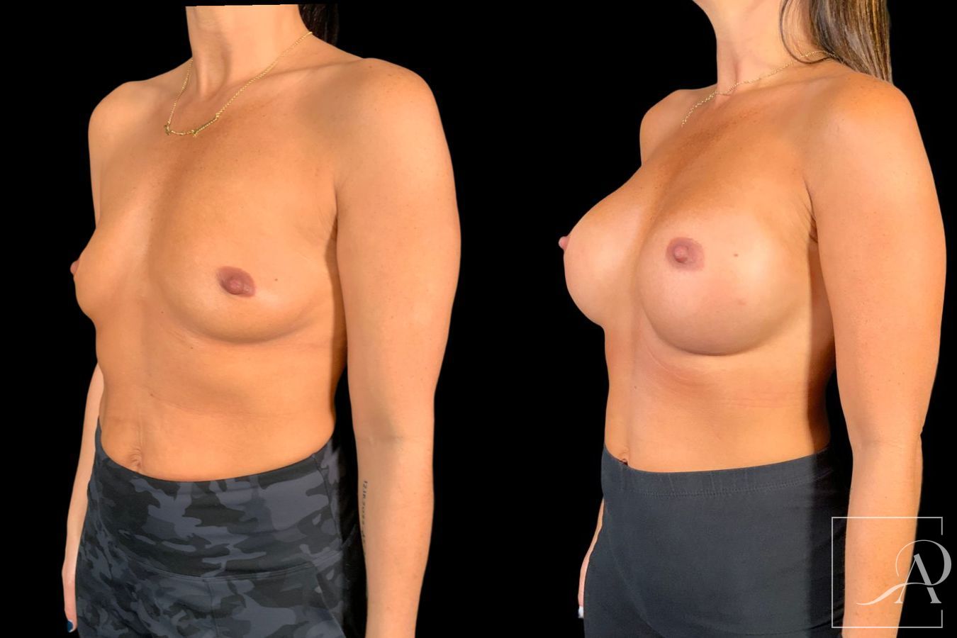 Before and after Breast Augmentation case 49552 - Angle 2
