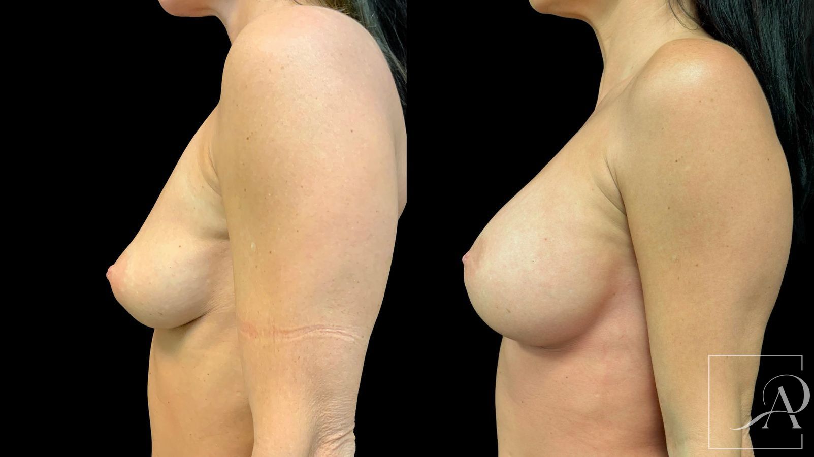 Before and after Breast Augmentation case 43363 - Angle 3