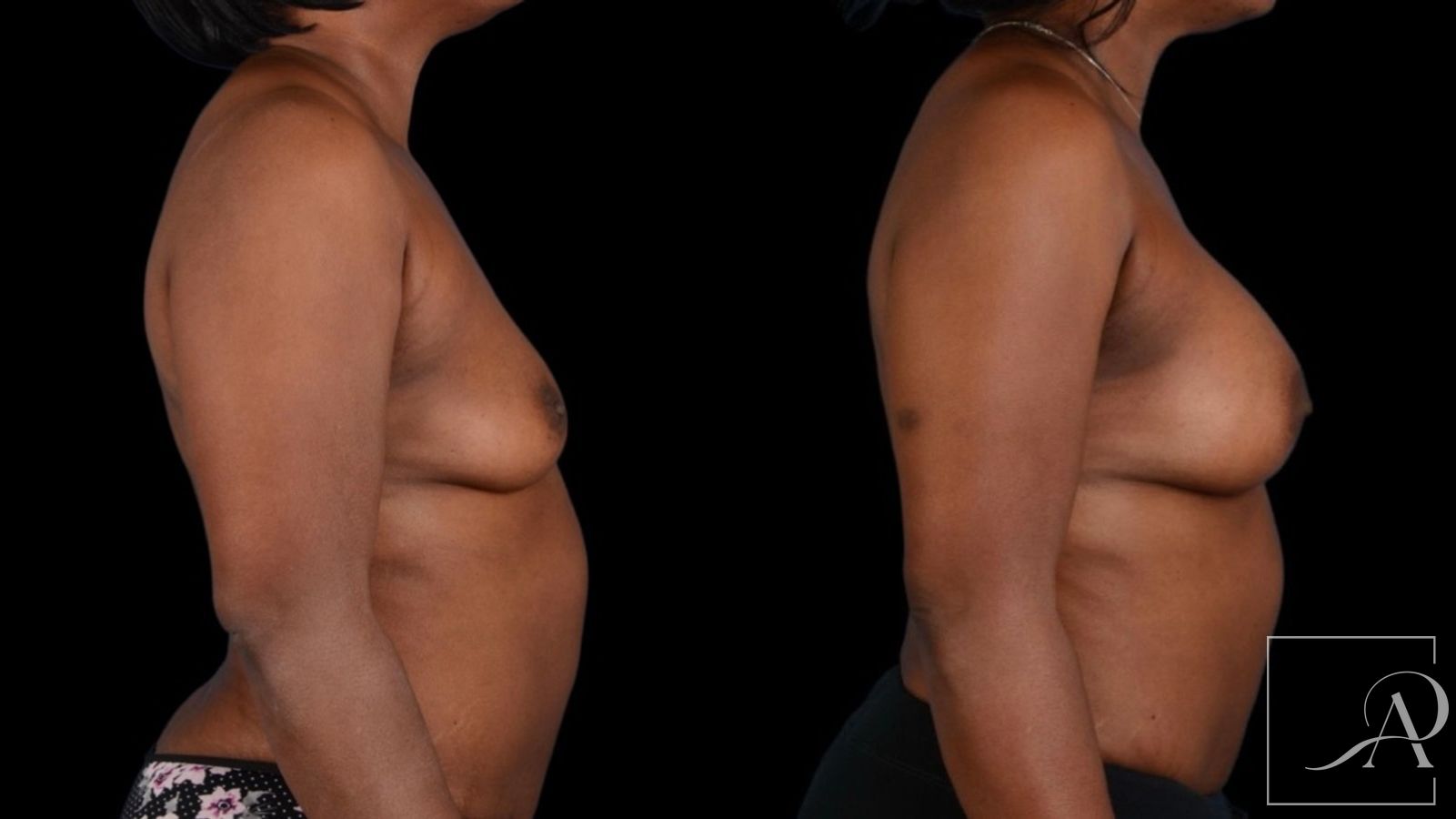Before and after Breast Augmentation case 43366 - Angle 5