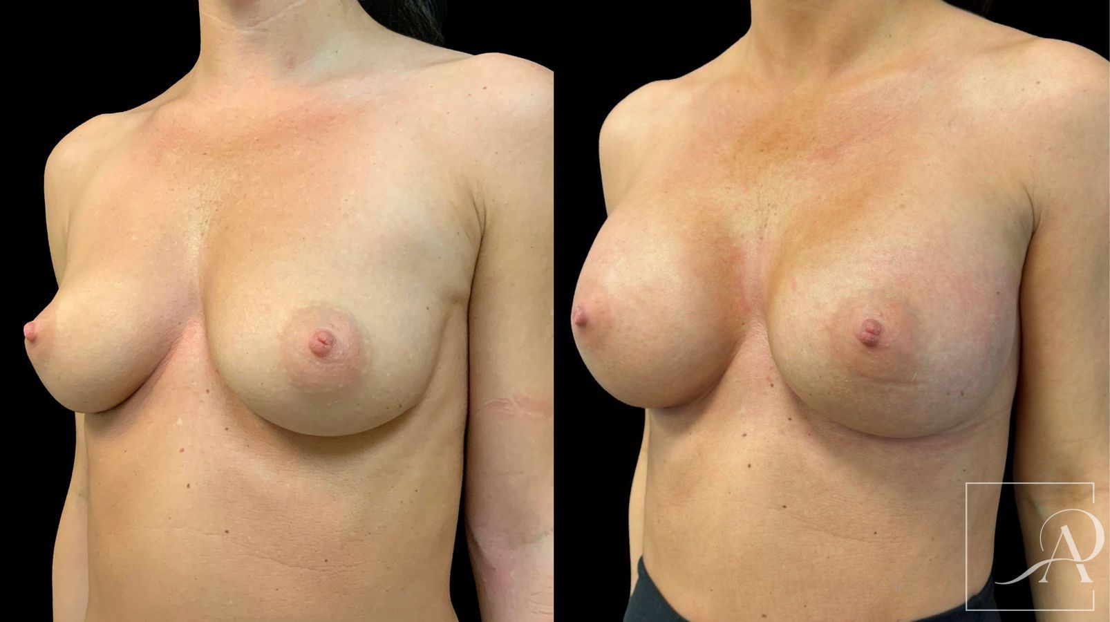 Before and after Breast Augmentation case 43363 - Angle 2