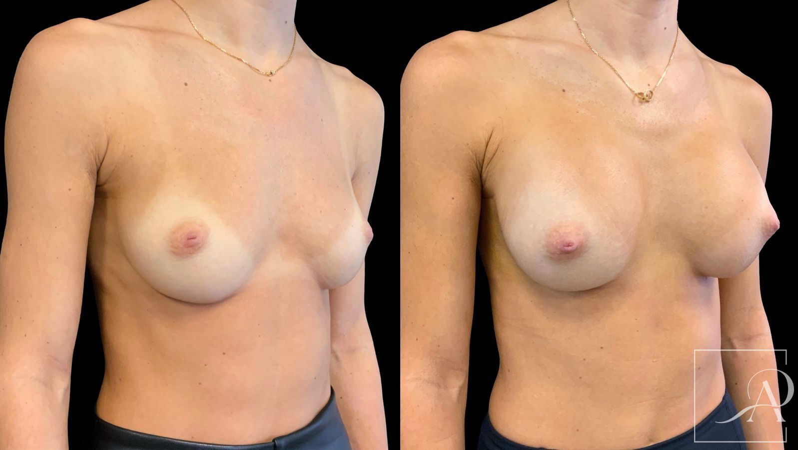 Before and after Breast Augmentation case 43365 - Angle 4