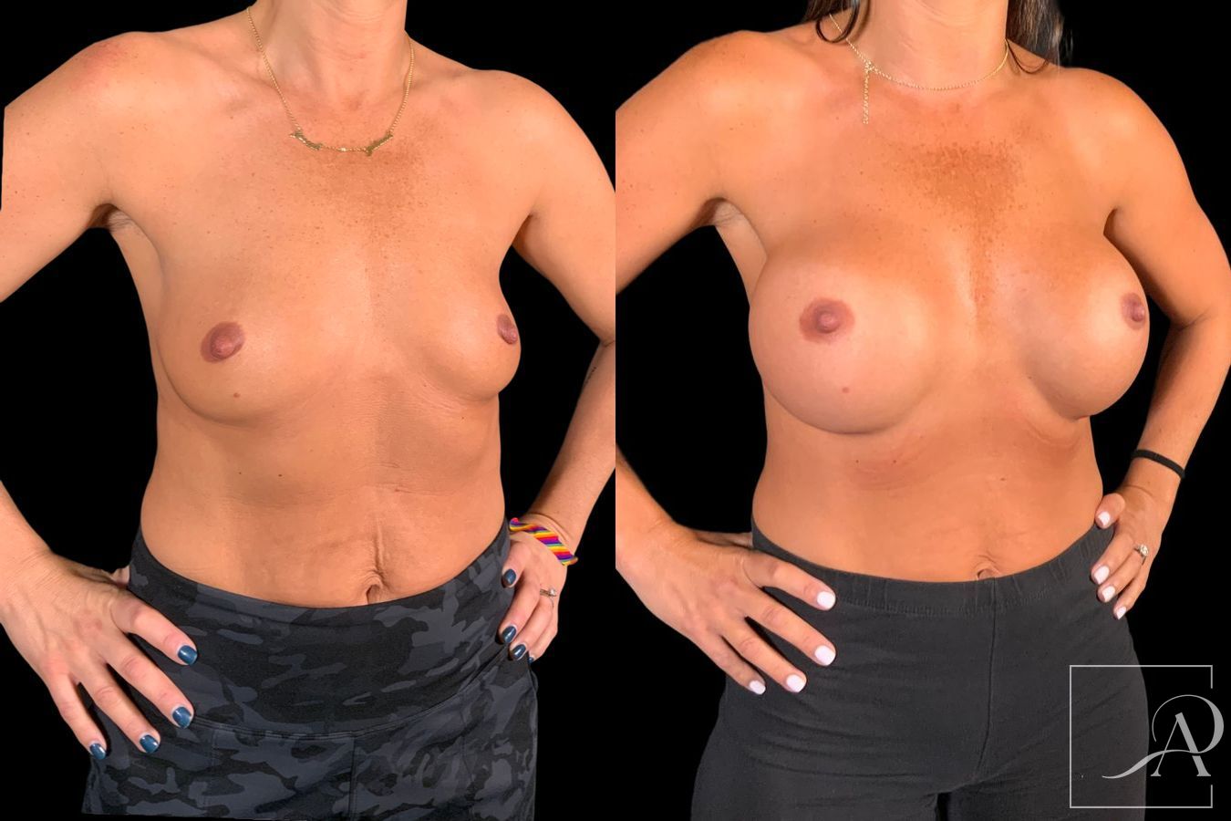 Before and after Breast Augmentation case 49552 - Angle 6