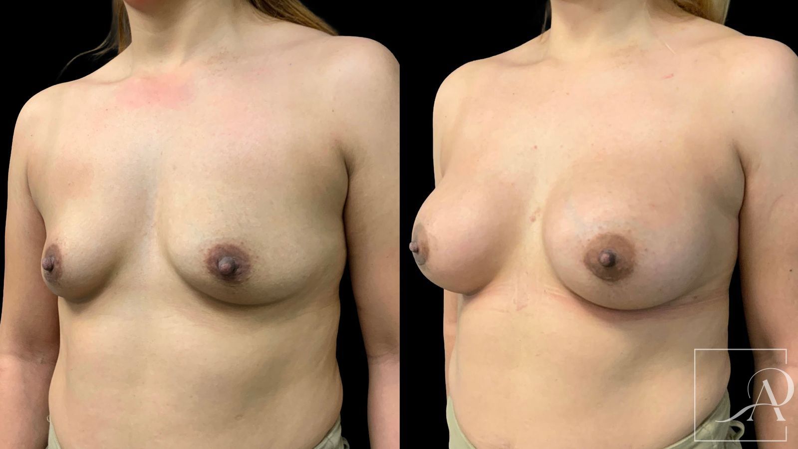 Before and after Breast Augmentation case 43364 - Angle 2