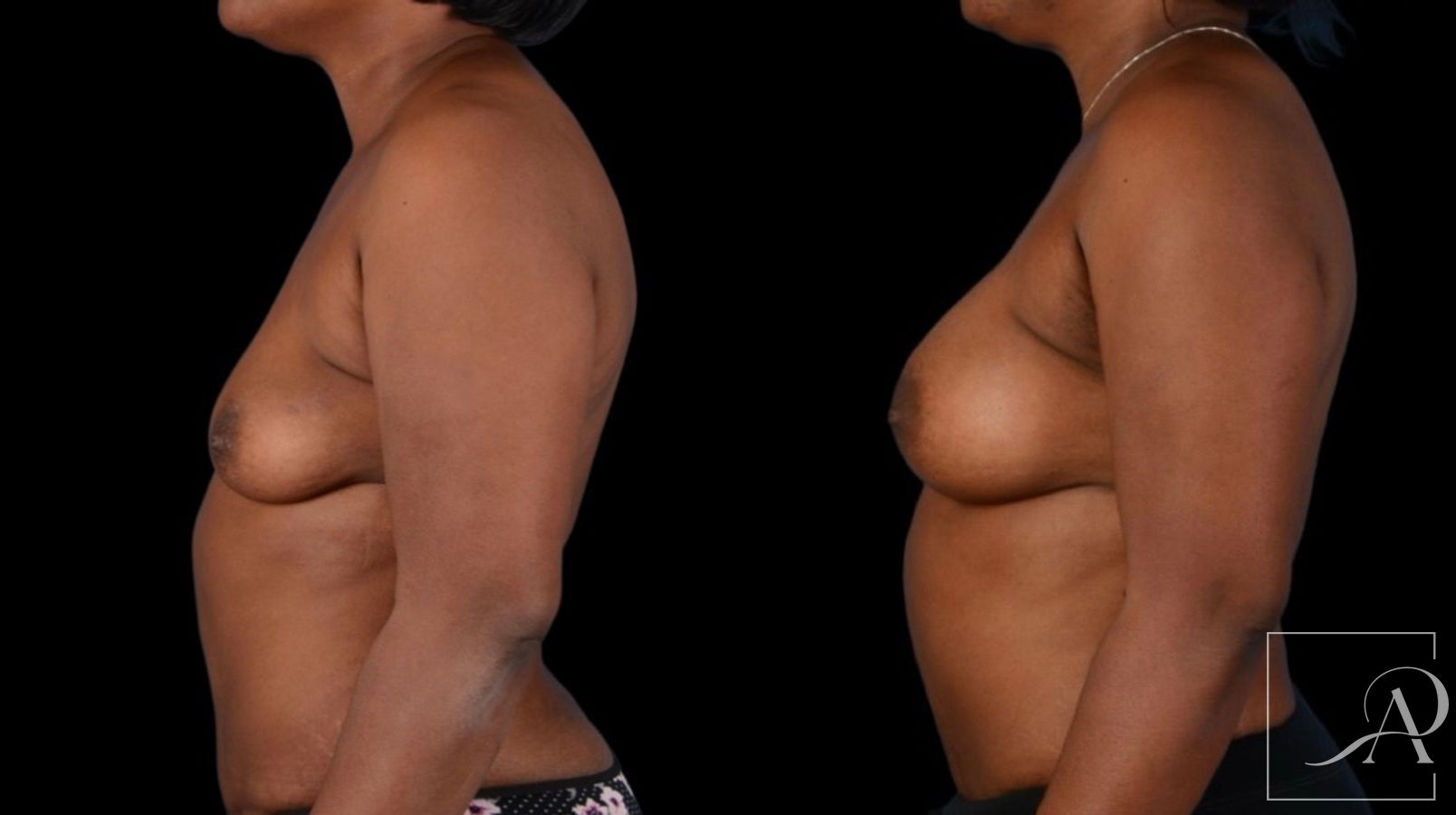 Before and after Breast Augmentation case 43366