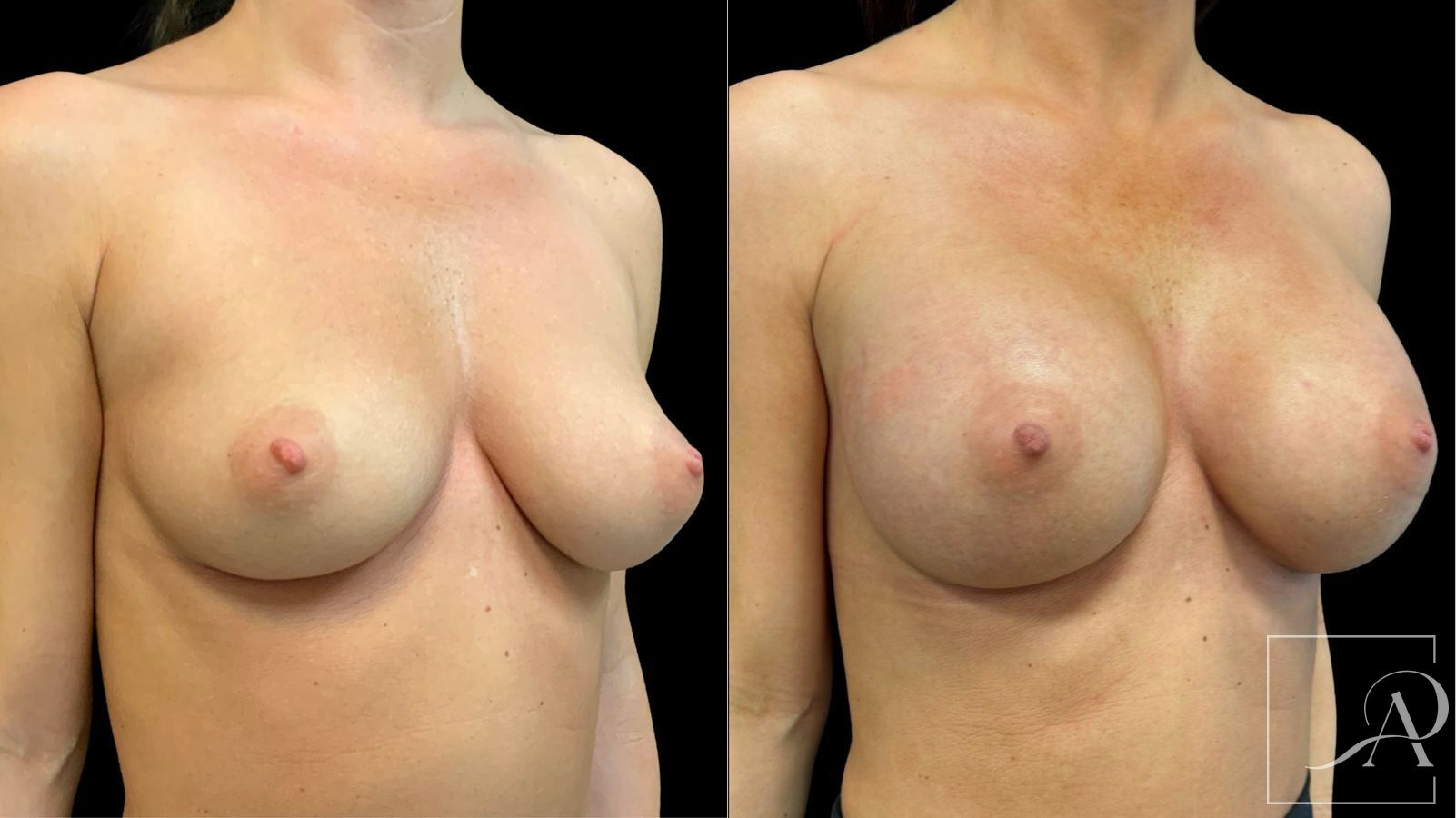 Before and after Breast Augmentation case 43363 - Angle 4