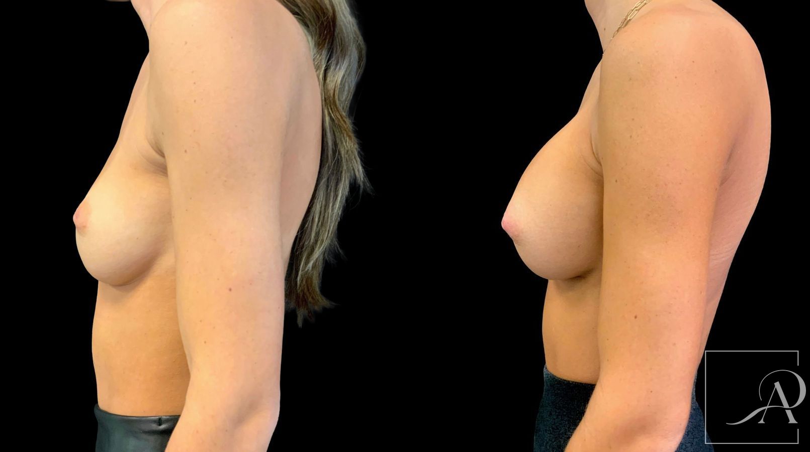 Before and after Breast Augmentation case 43365 - Angle 3