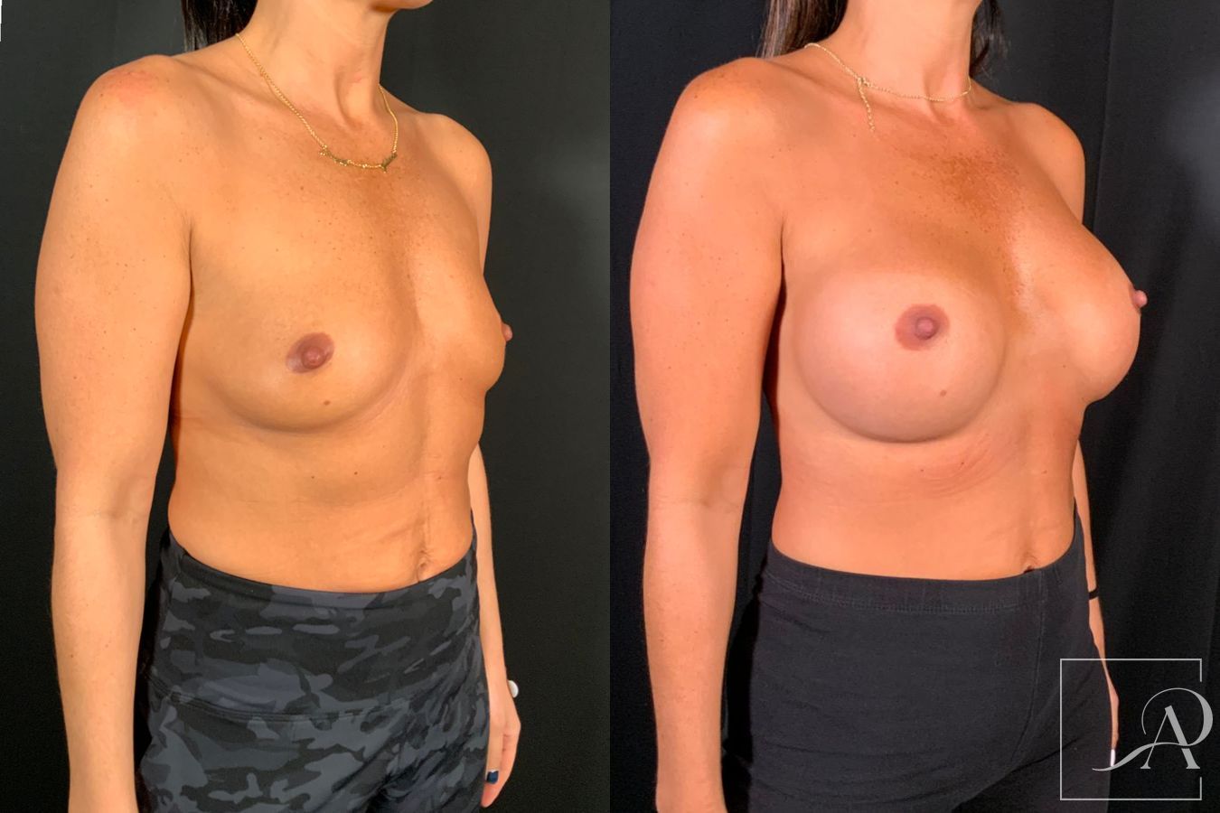 Before and after Breast Augmentation case 49552 - Angle 7