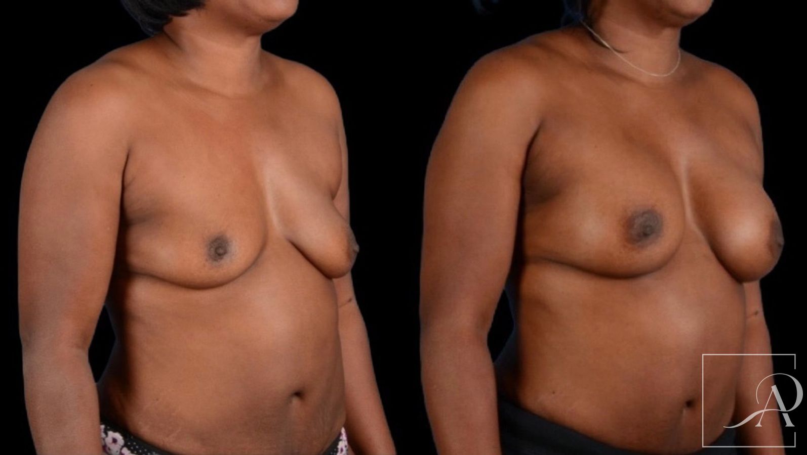 Before and after Breast Augmentation case 43366 - Angle 4