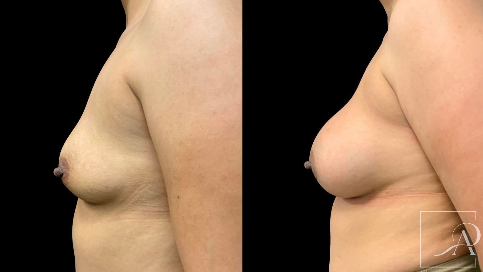 Before and after Breast Augmentation case 43364 - Angle 3