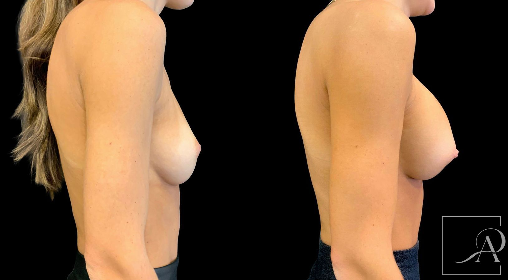 Before and after Breast Augmentation case 43365 - Angle 5